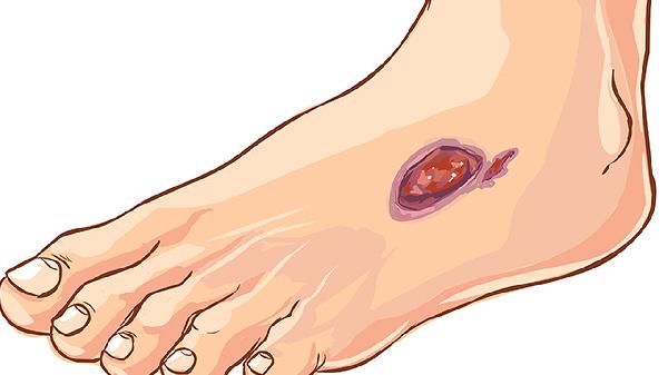 前庭大腺脓肿快速治疗方法有哪些