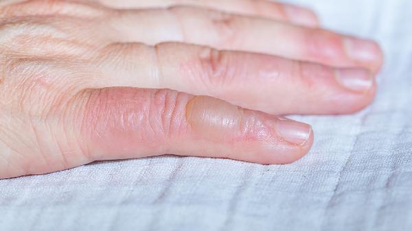 食指长水疱是什么原因引起的