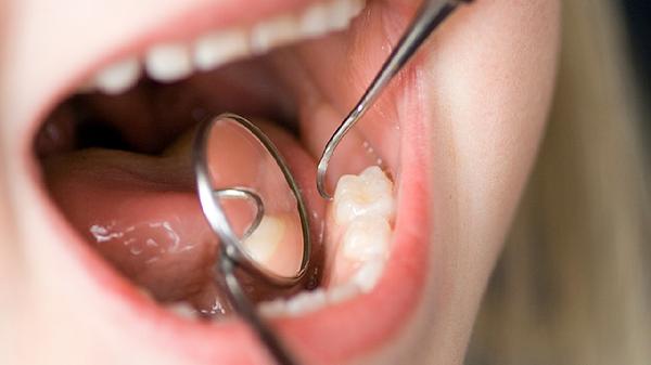 漱口水对牙结石有用吗  这几个方法消除牙结石很实用