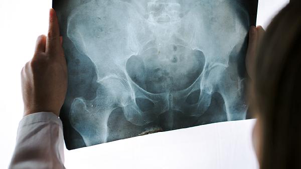 盆骨歪斜怎么矫正 盆骨歪斜的3个矫正方法须知