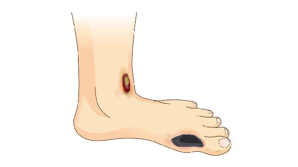 左脚侧面疼是什么原因引起的