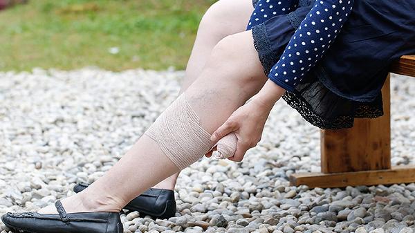 小腿露青筋怎么治疗 小腿露青筋的几个疗法详述