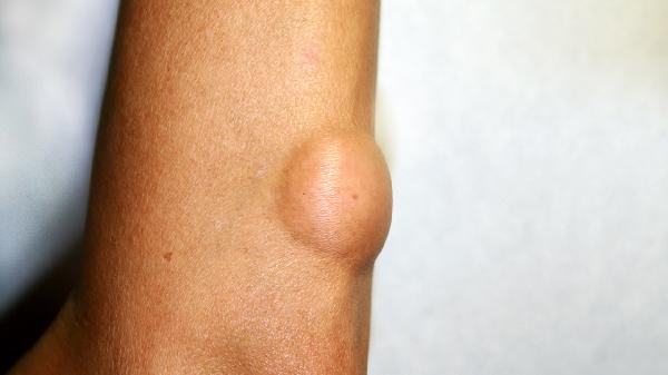 腹膜后纤维瘤如何治疗 治疗腹膜后纤维瘤4方法揭秘