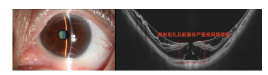 广州番禺爱尔眼科俞晓艺教授团队成功实施高难度复合手术,患者濒危视力提升10倍