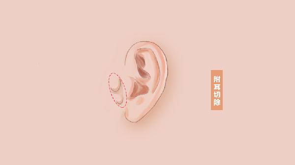 附耳切除后會(huì)再長(zhǎng)嗎會(huì)留疤嗎多久可以碰水
