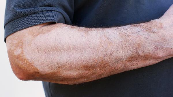 如何控制白斑不扩散