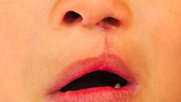 完全性腭裂可以治好吗