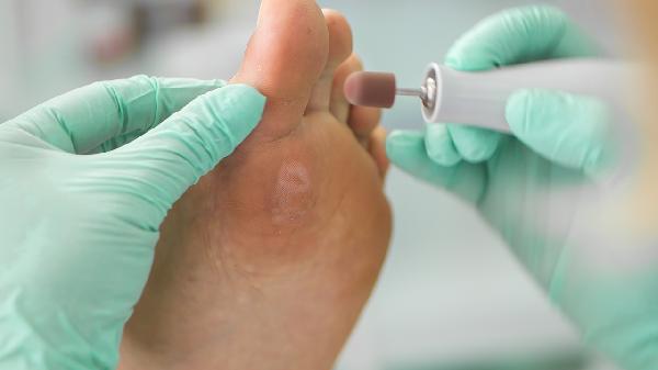 鸡眼不治疗会有什么后果