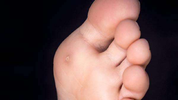 腳上長跖疣如何治療