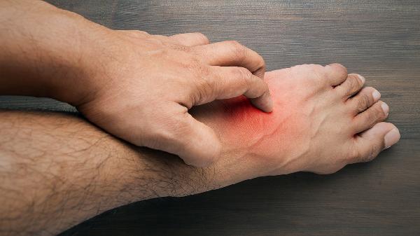 皮肌炎會(huì)引起腳腫嗎