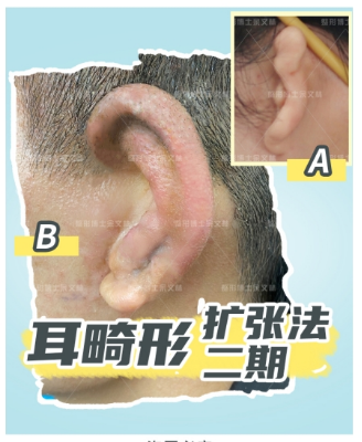 广药附一余文林解析：小耳畸形耳再造手术是否会留疤？