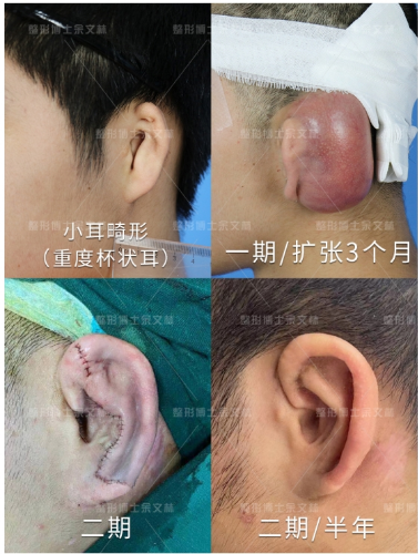 广药附一余文林解析：小耳畸形耳再造手术是否会留疤？