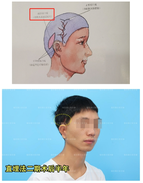 广药附一余文林解析：小耳畸形耳再造手术是否会留疤？