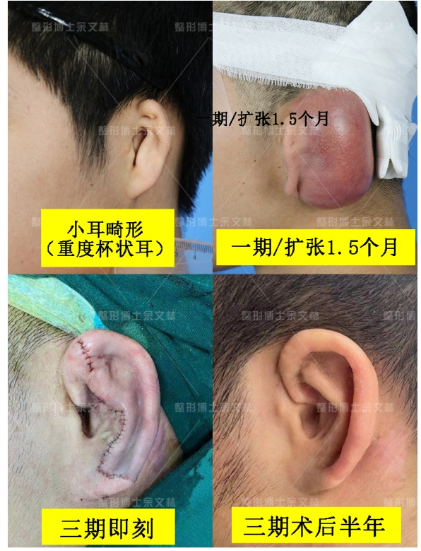 广药附一余文林解析：扩张法怎么注水？注水细节大公开