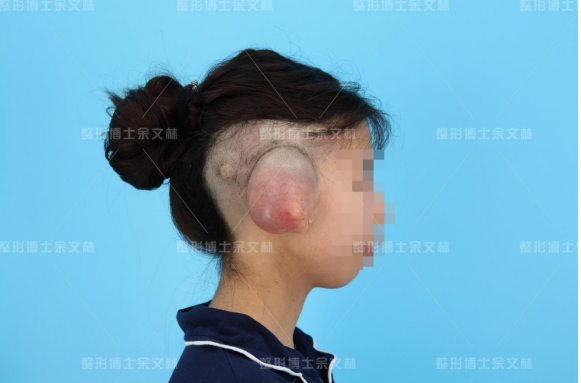 广药附一余文林解析：扩张法怎么注水？注水细节大公开