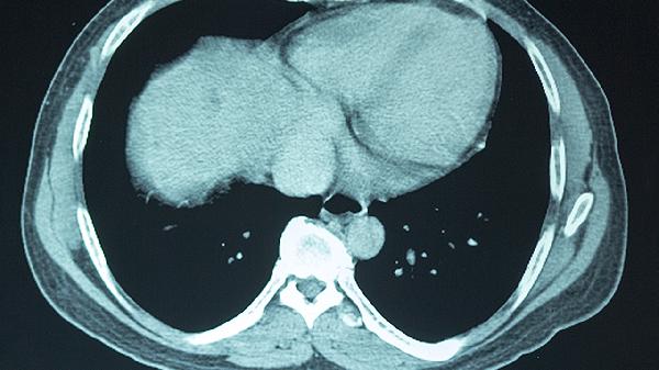 大脑前额叶的功能受损锻炼方法是什么