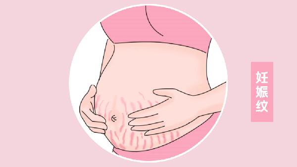 如何预防孕期妊娠纹