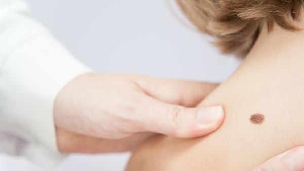 不规则黑色素痣有必要切除吗