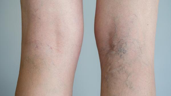 大腿根部肉很多怎么减下去