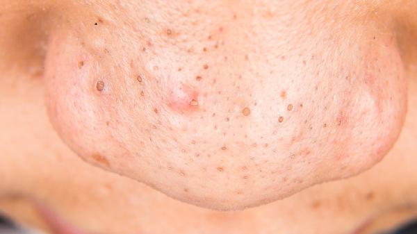 阿莫西林能去除黑头吗