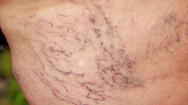 为什么胖只胖屁股大腿和肚子