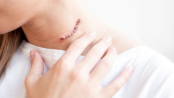 颈肌劳损怎么办 颈肌劳损的正确处理方法介绍