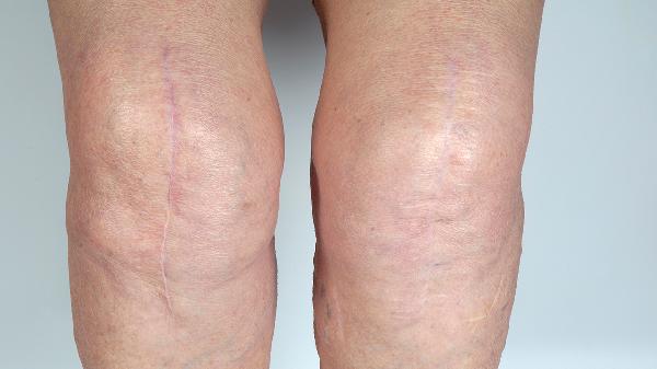 膝盖不肿不痛蹲下就疼怎么办