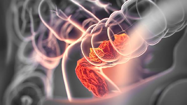 慢性小肠假性梗阻的临床表现有哪些