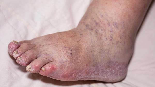 先天性足畸形病因有哪些 先天性足畸形的3因素很少人知