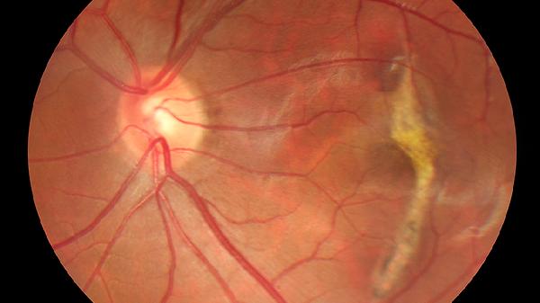 得过带状疱疹容易得癌是真的吗？得了带状疱疹如何做好预后？