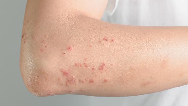 得了血小板减少性紫癜怎么办