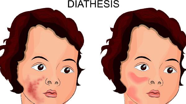 聚合性痤疮是由什么原因引起的 聚合性痤疮的5个原因揭晓