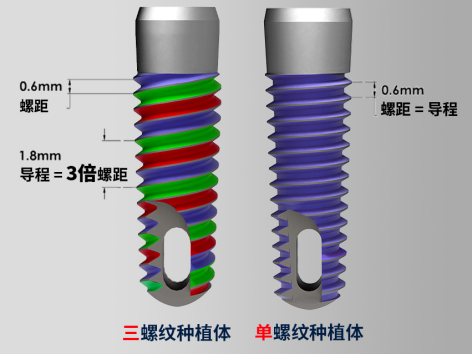 三螺纹种植体为何能快3倍?揭秘进口种植体的 “速度与舒适” 真相