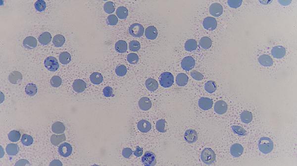 ASCUS合并HPV16癌症几率是多少