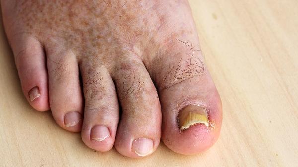 指甲缝长了一根硬硬的倒刺怎么回事，怎么办