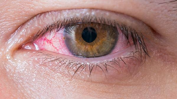 眼睛干涩疼怎么办 四种方法护眼不干涩