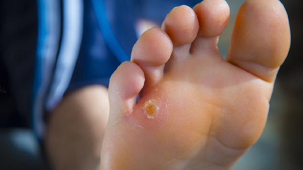 鸡眼的治疗误区有哪些 治疗鸡眼4个误区别触碰