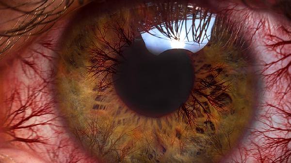 如何治疗红眼病 四个简单方法有效远离治疗红眼病