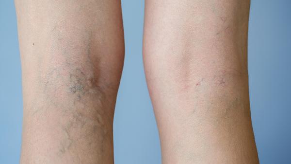 睡眠肌阵挛注意事项有哪些