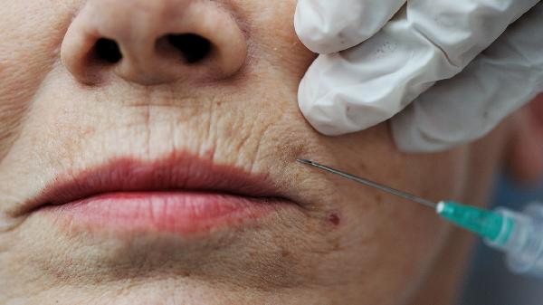 脸上皱纹去掉的最好方法是什么