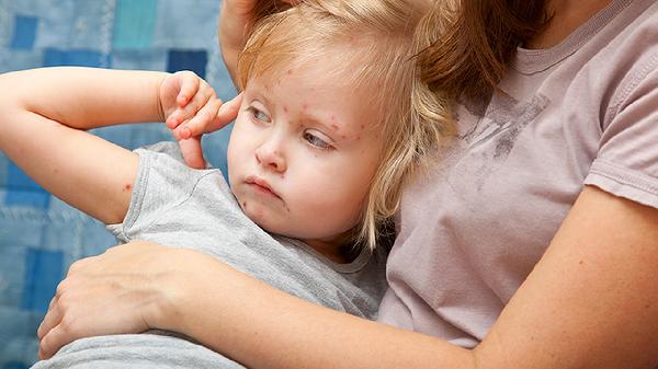 点阵激光真的可以去痘坑吗