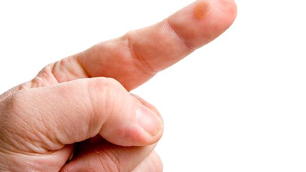 烫伤十天了伤口发白是溃烂吗