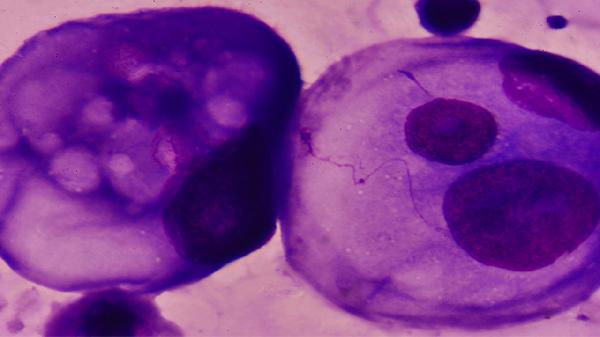 癌症手术后，总担心再次复发？术后5年内建议养成5个习惯