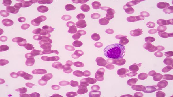 直乙交界处腺癌最佳治疗方案