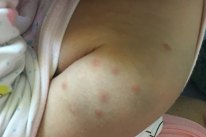 毛囊炎一直在扩散怎么控制