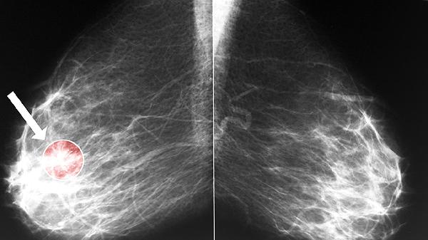 直乙交界处腺癌最佳治疗方案