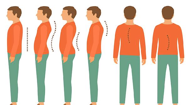 强直性脊柱炎是怎么回事 多因素互相影响的结果