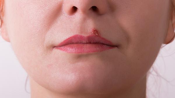 营养不良性口角炎的表现有哪些