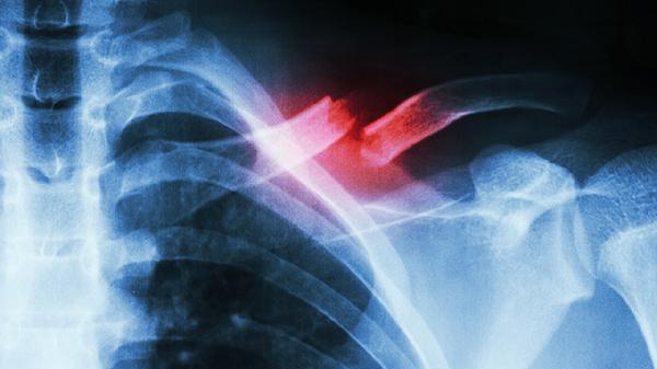 肋软骨炎是怎么回事 从4方面认识肋软骨炎的病因