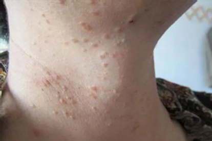 扁平疣是怎么导致的 导致扁平疣2大病因揭秘